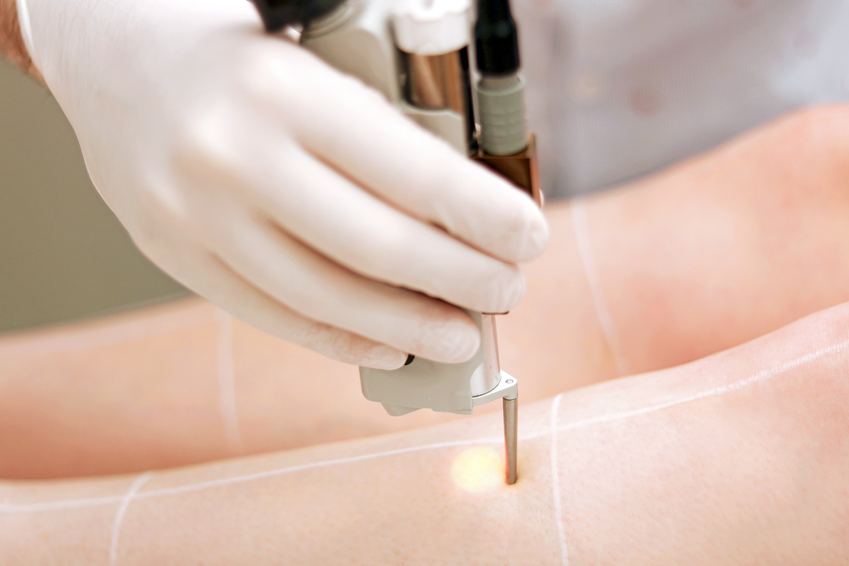 epilation-definitive-centre-laser-lyon